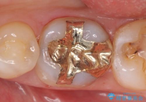 PGA(ゴールド)インレー　虫歯治療の治療後