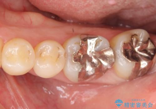 銀歯の周りが虫歯　セラミックにの治療前