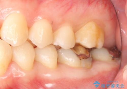 銀歯の周りが虫歯　セラミックにの治療前