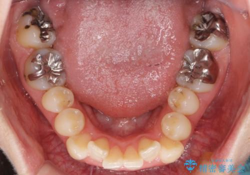 30代女性　インビザラインで前歯をキレイに　マウスピース矯正の治療前
