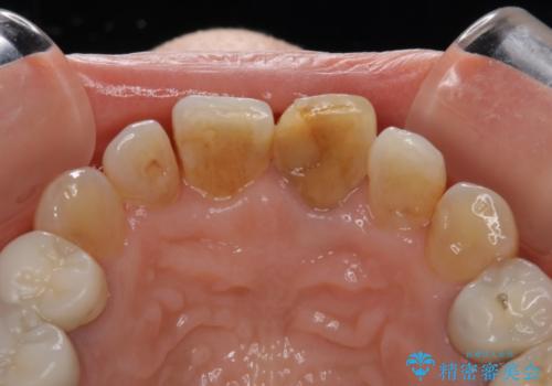 咬み合わせの修正を含めた前歯のオールセラミック修復　神経のない歯は根管治療からの治療中
