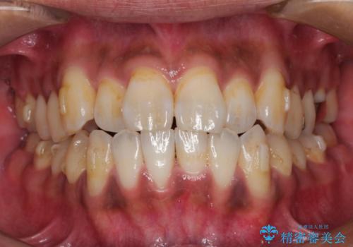 マウスピース矯正の代名詞　インビザラインによる前歯のクロスバイト治療の治療中