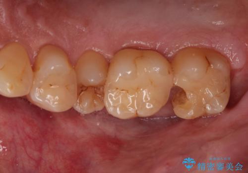 つめものが欠けた 奥歯のセラミックインレーの症例 治療前