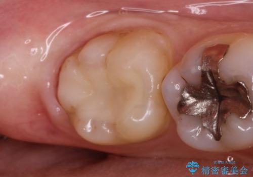銀歯の内側で虫歯が再発　セラミックインレー修復で再発しないように