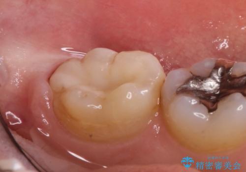 銀歯の内側で虫歯が再発　セラミックインレー修復で再発しないようにの治療後