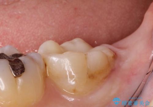 銀歯の内側で虫歯が再発　セラミックインレー修復で再発しないようにの治療後