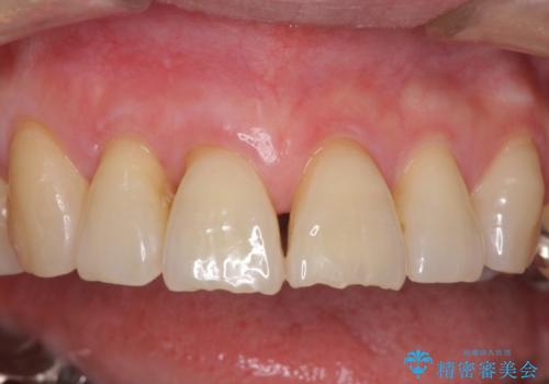 歯ぐきがこれ以上下がるのがいやだ　歯肉移植による根面被覆と歯肉退縮の予防の治療後