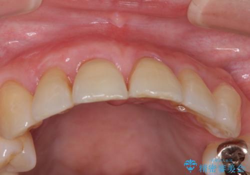 歯ぐきがこれ以上下がるのがいやだ　歯肉移植による根面被覆と歯肉退縮の予防の治療後
