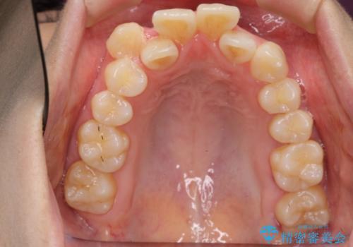 右だけ八重歯　最少限の抜歯の治療前