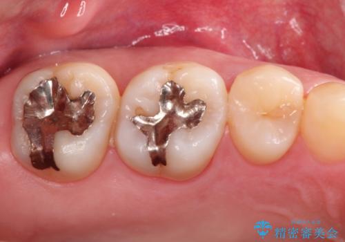 矯正後により美しい歯への症例 治療前