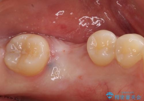 歯の根が割れた　インプラント治療によるかみ合わせの回復の治療中