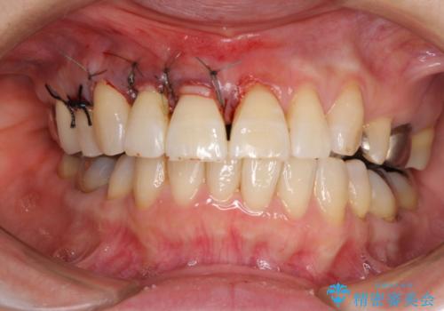 歯ぐきがこれ以上下がるのがいやだ　歯肉移植による根面被覆と歯肉退縮の予防の治療中