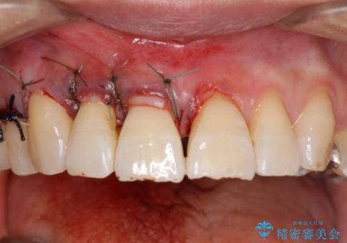 歯ぐきがこれ以上下がるのがいやだ　歯肉移植による根面被覆と歯肉退縮の予防の治療中