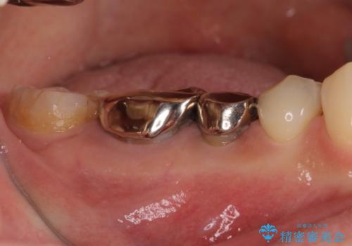 奥の銀歯をきれいにしたい　オールセラミッククラウンによる審美歯科治療の治療前