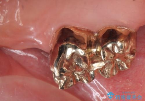 金属床義歯・PGA(ゴールド)クラウン　合わない入れ歯の新製　の治療後