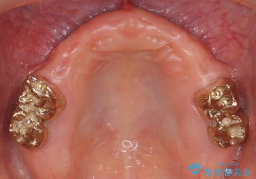 金属床義歯・PGA(ゴールド)クラウン　合わない入れ歯の新製　の治療後