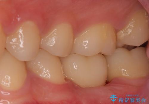 歯の根が割れた　インプラント治療によるかみ合わせの回復の症例 治療後