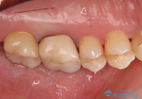 奥歯にものが詰まる　最後方臼歯の被せもので改善するの治療後