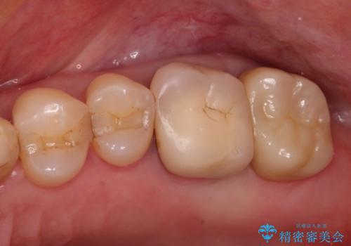 奥歯にものが詰まる　最後方臼歯の被せもので改善するの症例 治療後