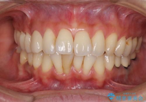変色した前歯をセラミッククラウンで自然な前歯にの治療後