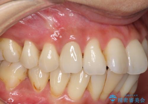 変色した前歯をセラミッククラウンで自然な前歯にの治療後