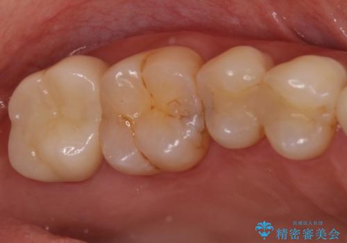 治療途中の奥歯をセラミックに　根管治療と審美歯科治療の治療後