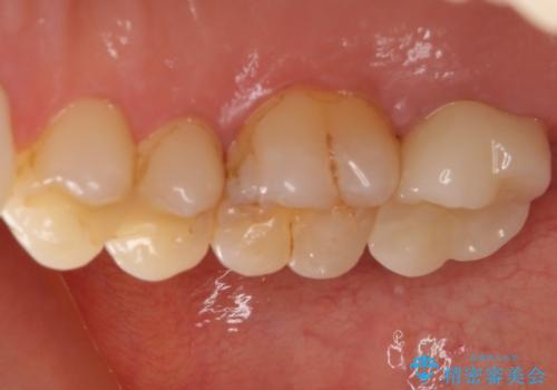 治療途中の奥歯をセラミックに　根管治療と審美歯科治療の治療後