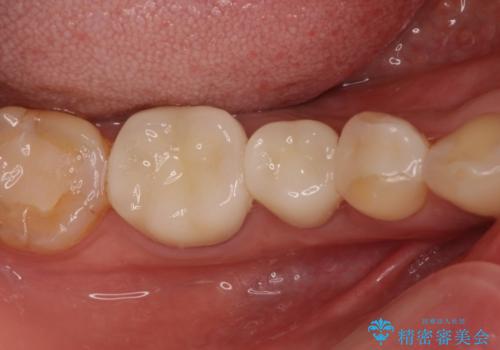 奥の銀歯をきれいにしたい　オールセラミッククラウンによる審美歯科治療