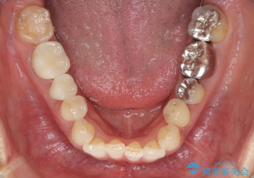 奥の銀歯をきれいにしたい　オールセラミッククラウンによる審美歯科治療の治療後
