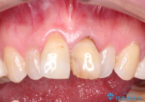 咬み合わせの修正を含めた前歯のオールセラミック修復　神経のない歯は根管治療からの治療前