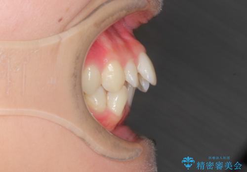 前歯のガタガタをキレイに　(費用を抑えたメタル装置)の治療前