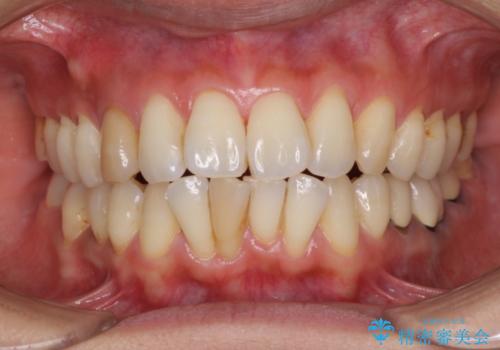 変色した前歯をセラミッククラウンで自然な前歯にの治療前