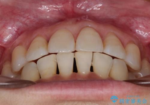 インビザラインによるかみ合わせの治療　奥歯の位置関係を是正してガタつきを治すの治療後