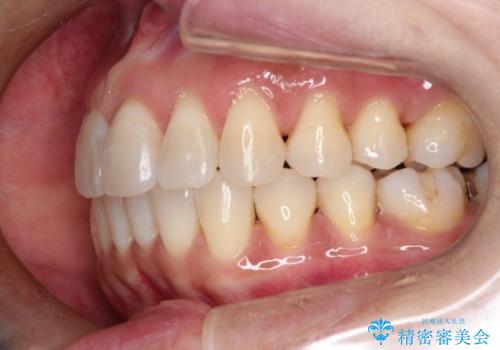 インビザラインによるかみ合わせの治療　奥歯の位置関係を是正してガタつきを治すの治療後