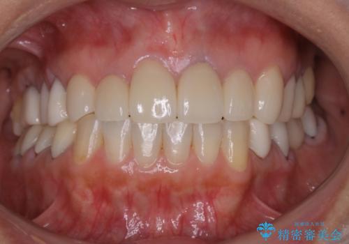 咬み合わせの修正を含めた前歯のオールセラミック修復　神経のない歯は根管治療からの治療後
