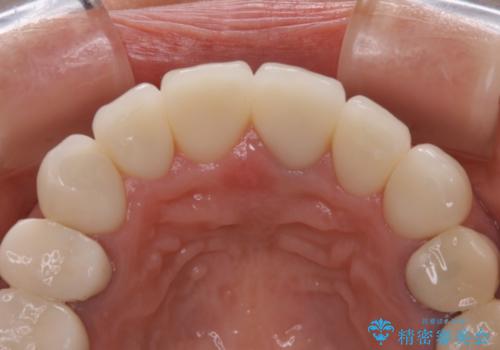 咬み合わせの修正を含めた前歯のオールセラミック修復　神経のない歯は根管治療からの治療後