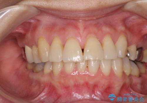歯ぐきがこれ以上下がるのがいやだ　歯肉移植による根面被覆と歯肉退縮の予防の治療前