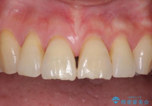歯ぐきがこれ以上下がるのがいやだ　歯肉移植による根面被覆と歯肉退縮の予防の治療前
