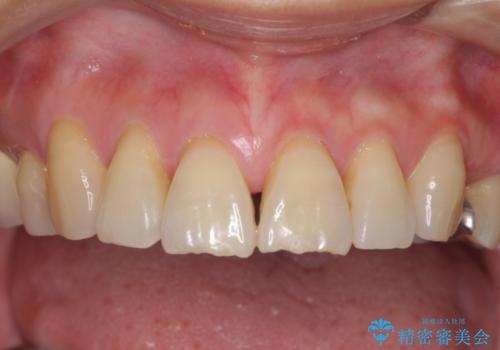 歯ぐきがこれ以上下がるのがいやだ　歯肉移植による根面被覆と歯肉退縮の予防