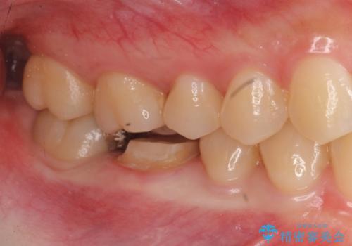 歯の高さがなく、被せ物が外れる　歯周外科手術で解決