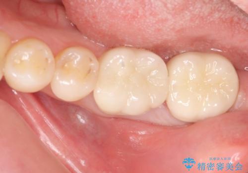 銀歯の周りが虫歯　セラミックにの症例 治療後