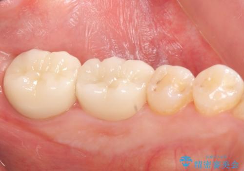 銀歯の周りが虫歯　セラミックにの治療後