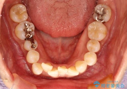 インビザラインによるかみ合わせの治療　奥歯の位置関係を是正してガタつきを治すの治療前