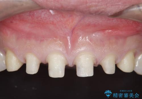 オールセラミッククラウン　上顎前歯部の隙間をセラミック矯正での治療中