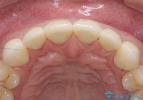 オールセラミッククラウン　上顎前歯部の隙間をセラミック矯正での治療後