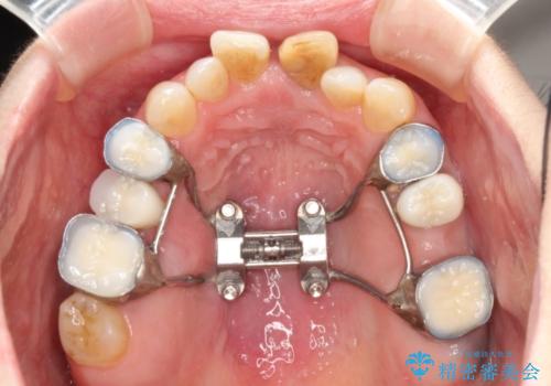 咬み合わせの修正を含めた前歯のオールセラミック修復　神経のない歯は根管治療から
