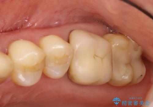 奥歯にものが詰まる　最後方臼歯の被せもので改善するの症例 治療前