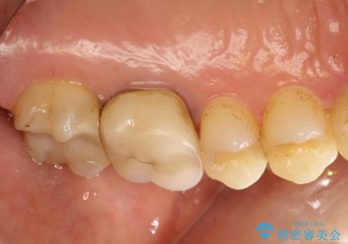 奥歯にものが詰まる　最後方臼歯の被せもので改善するの治療前