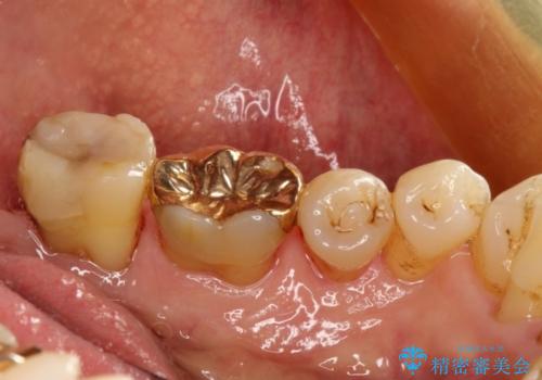 古い材料が欠けてしまった奥歯の修復補綴の症例 治療前