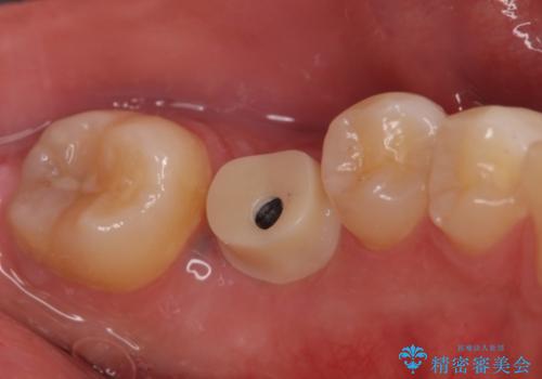 歯の根が割れた　インプラント治療によるかみ合わせの回復の治療後